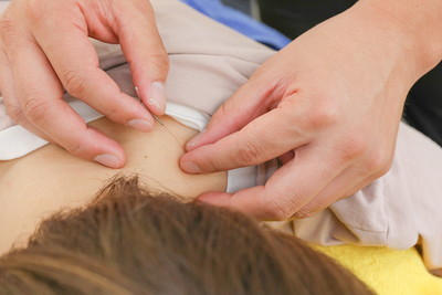 阿佐ヶ谷中央整骨院での鍼施術の様子